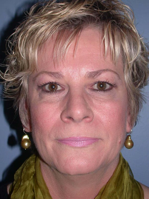 Brow Lift in San Francisco Before and After