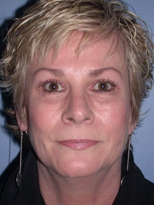 Brow Lift in San Francisco Before and After