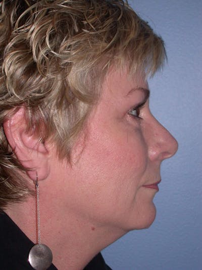 Brow Lift Gallery Before & After Gallery - Patient 4756900 - Image 4
