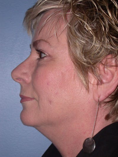 Brow Lift Gallery Before & After Gallery - Patient 4756900 - Image 6