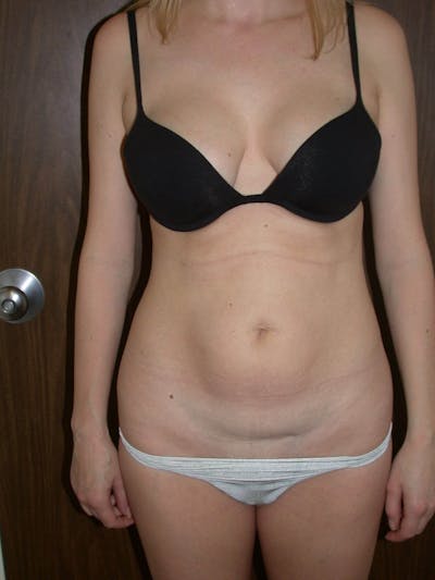 Tummy Tuck Gallery Before & After Gallery - Patient 4756902 - Image 1