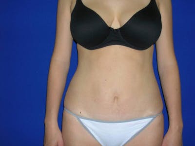 Tummy Tuck Gallery Before & After Gallery - Patient 4756902 - Image 2