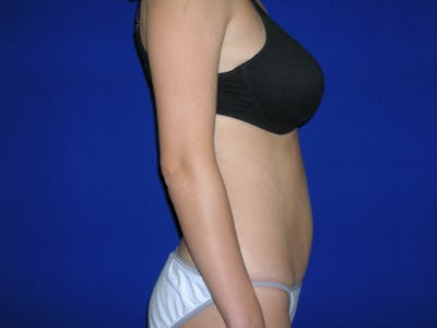 Tummy Tuck Gallery Before & After Gallery - Patient 4756902 - Image 4