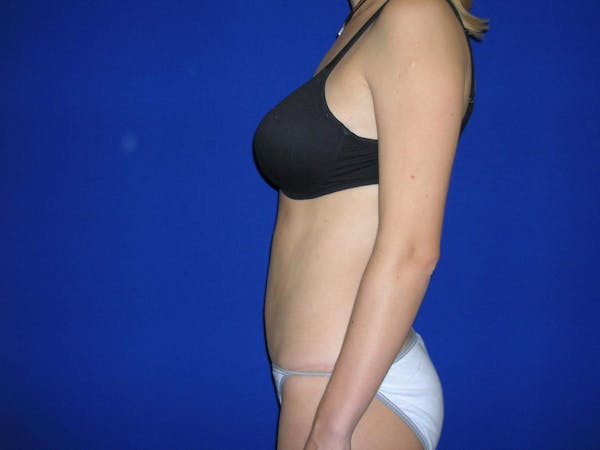 Tummy Tuck Gallery Before & After Gallery - Patient 4756902 - Image 6