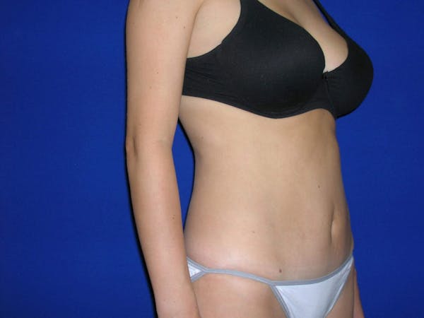 Tummy Tuck Before & After Gallery - Patient 4756902 - Image 8
