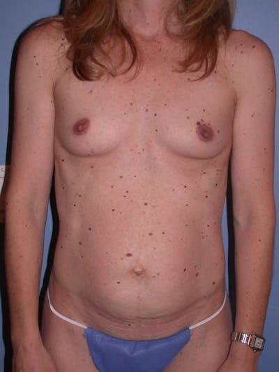 Tummy Tuck Gallery Before & After Gallery - Patient 4756905 - Image 1