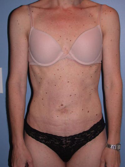 Tummy Tuck Gallery Before & After Gallery - Patient 4756905 - Image 2