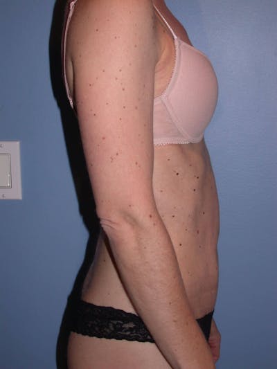 Tummy Tuck Before & After Gallery - Patient 4756905 - Image 4
