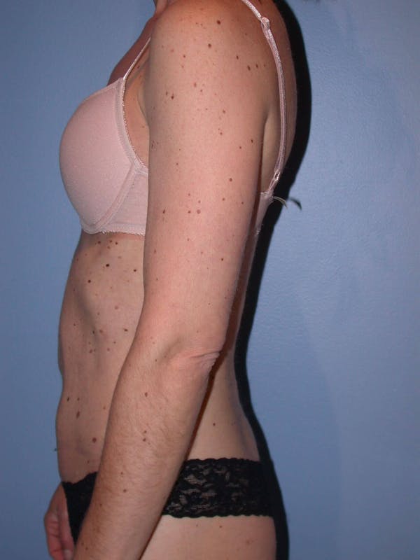 Tummy Tuck Gallery Before & After Gallery - Patient 4756905 - Image 6