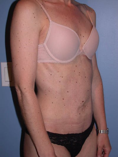 Tummy Tuck Gallery Before & After Gallery - Patient 4756905 - Image 8