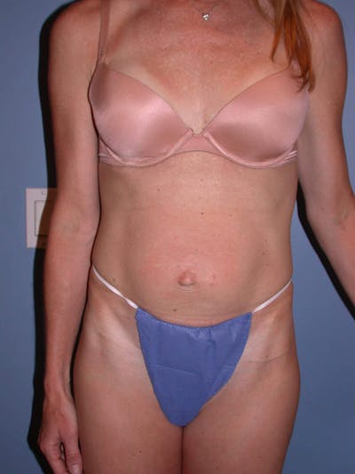 Tummy Tuck Gallery Before & After Gallery - Patient 4756911 - Image 1