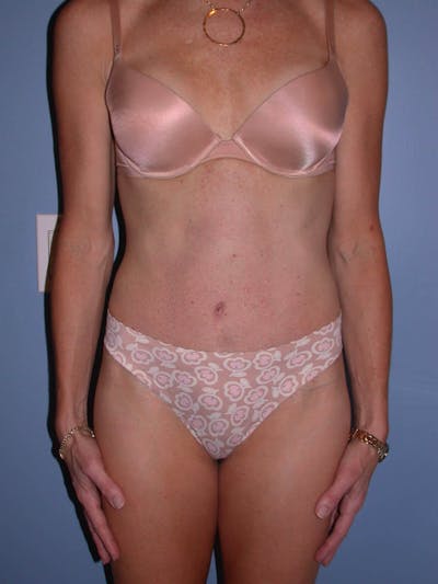 Tummy Tuck Gallery Before & After Gallery - Patient 4756911 - Image 2