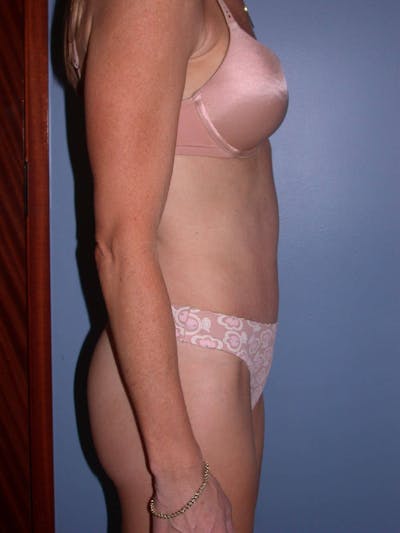 Tummy Tuck Gallery Before & After Gallery - Patient 4756911 - Image 4