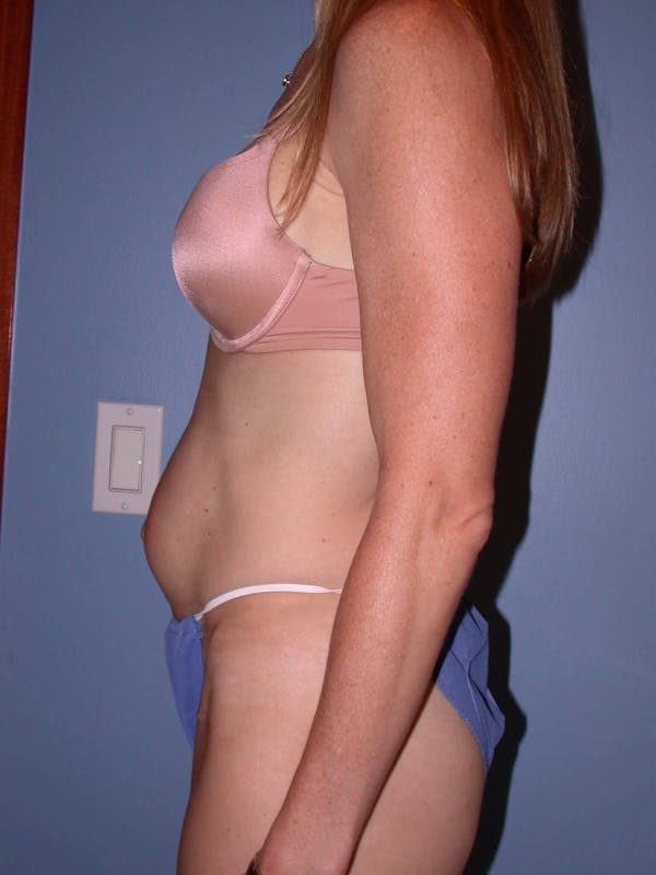 Tummy Tuck Gallery Before & After Gallery - Patient 4756911 - Image 5