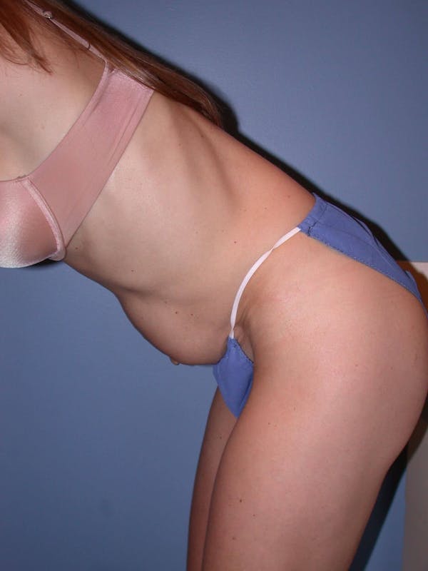 Tummy Tuck Gallery Before & After Gallery - Patient 4756911 - Image 9