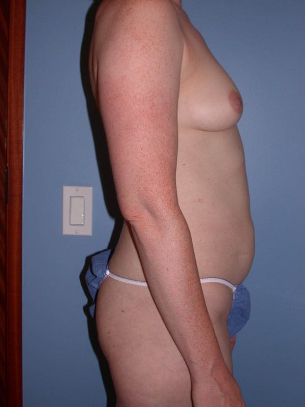 Tummy Tuck Gallery Before & After Gallery - Patient 4756918 - Image 3