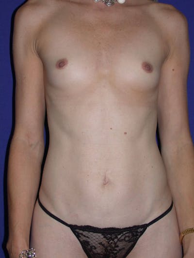 Tummy Tuck Gallery Before & After Gallery - Patient 4756925 - Image 1