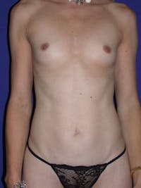 Tummy Tuck Before & After Gallery - Patient 4756925 - Image 1