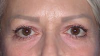 Eyelid Lift Gallery Before & After Gallery - Patient 4756924 - Image 1