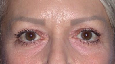 Eyelid Lift Gallery Before & After Gallery - Patient 4756924 - Image 1