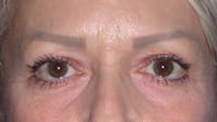Eyelid Lift Before & After Gallery - Patient 4756924 - Image 1