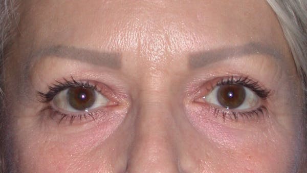 Eyelid Lift Before & After Gallery - Patient 4756924 - Image 1