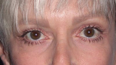 Eyelid Lift Gallery Before & After Gallery - Patient 4756924 - Image 2