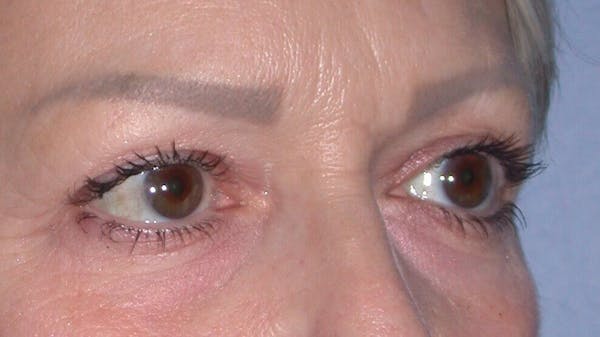 Eyelid Lift Gallery Before & After Gallery - Patient 4756924 - Image 3