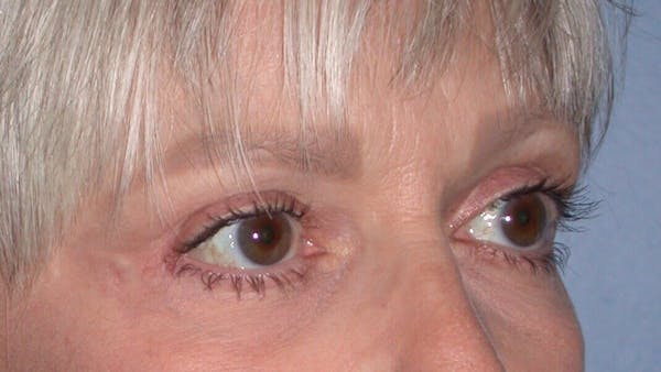 Eyelid Lift Gallery Before & After Gallery - Patient 4756924 - Image 4