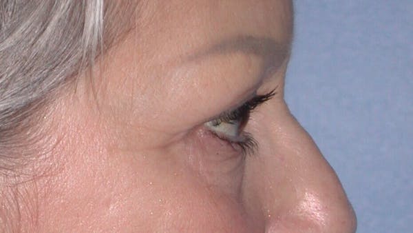 Eyelid Lift Gallery Before & After Gallery - Patient 4756924 - Image 5