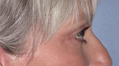 Eyelid Lift Gallery Before & After Gallery - Patient 4756924 - Image 6