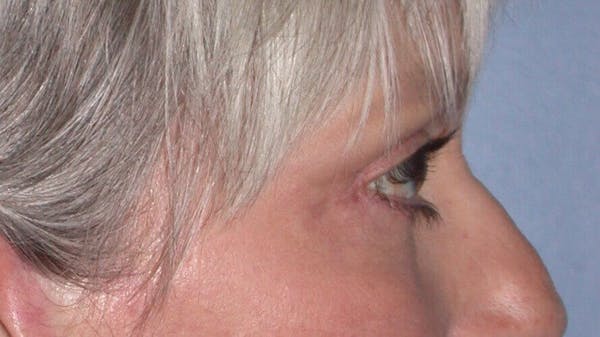 Eyelid Lift Before & After Gallery - Patient 4756924 - Image 6