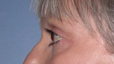 Eyelid Lift Gallery Before & After Gallery - Patient 4756924 - Image 8