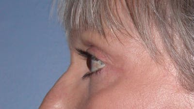 Eyelid Lift Before & After Gallery - Patient 4756924 - Image 8