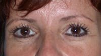 Eyelid Lift Gallery Before & After Gallery - Patient 4756929 - Image 1