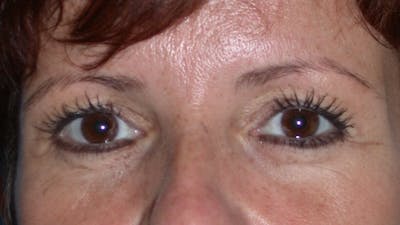 Eyelid Lift Gallery Before & After Gallery - Patient 4756929 - Image 1