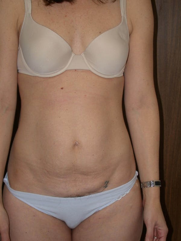 Tummy Tuck Gallery Before & After Gallery - Patient 4756931 - Image 1
