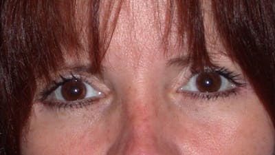Eyelid Lift Gallery Before & After Gallery - Patient 4756929 - Image 2