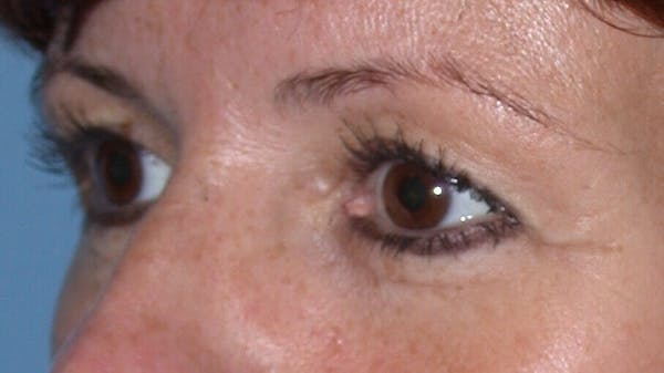 Eyelid Lift Gallery Before & After Gallery - Patient 4756929 - Image 3