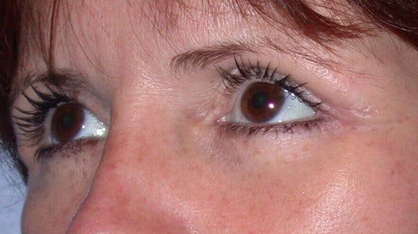 Eyelid Lift Gallery Before & After Gallery - Patient 4756929 - Image 4