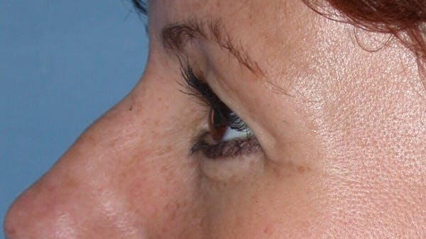 Eyelid Lift Gallery Before & After Gallery - Patient 4756929 - Image 5