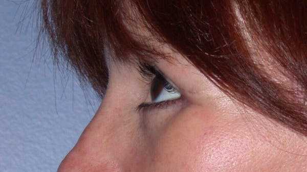Eyelid Lift Gallery Before & After Gallery - Patient 4756929 - Image 6