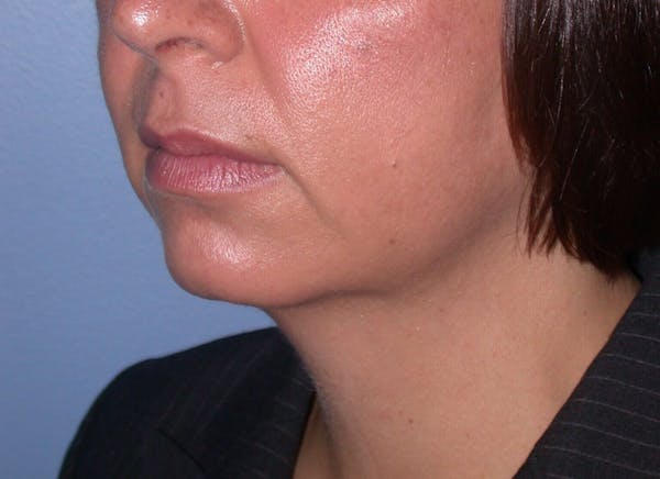 Chin Augmentation