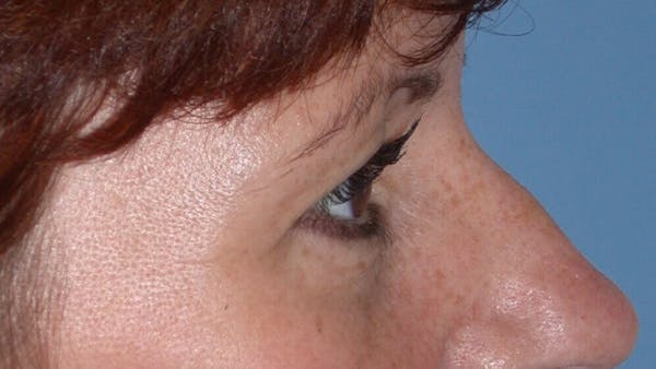 Eyelid Lift Gallery Before & After Gallery - Patient 4756929 - Image 7
