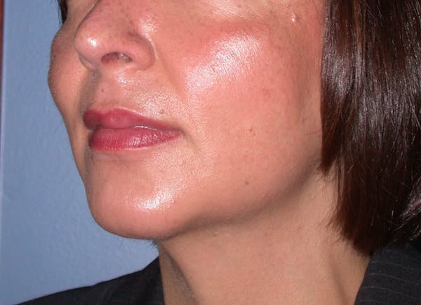 Chin Augmentation