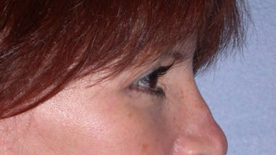 Eyelid Lift Gallery Before & After Gallery - Patient 4756929 - Image 8