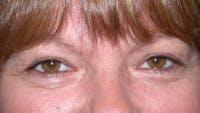 Eyelid Lift Gallery Before & After Gallery - Patient 4756937 - Image 1