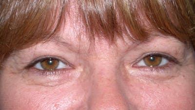 Eyelid Lift Gallery Before & After Gallery - Patient 4756937 - Image 1