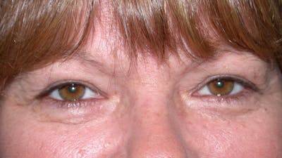 Eyelid Lift Before & After Gallery - Patient 4756937 - Image 1