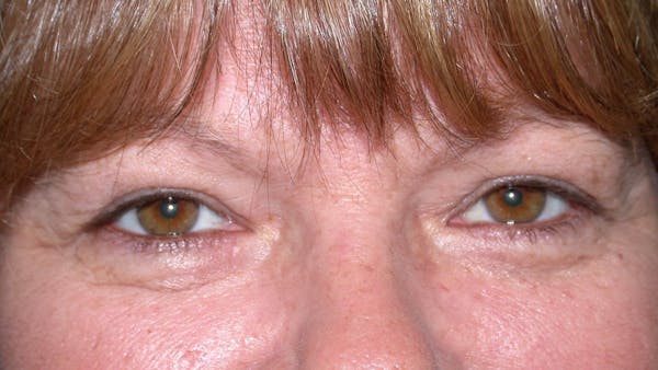Eyelid Lift Before & After Gallery - Patient 4756937 - Image 1